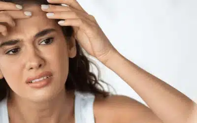How inhibiting tyrosinase even tones skin and heals acne scars?